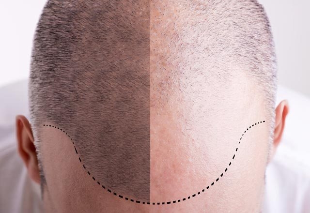 Hair Transplant Image 22