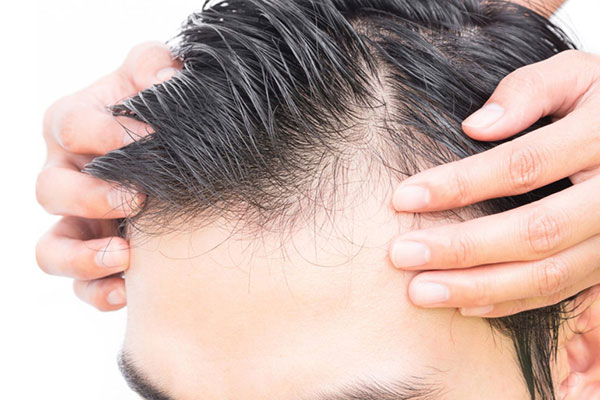 Hair Transplant Image 18