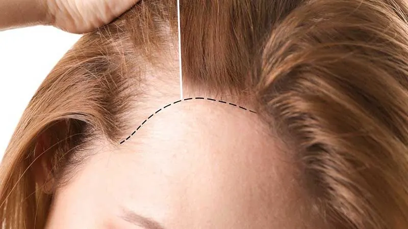 Hair Transplant Image 16
